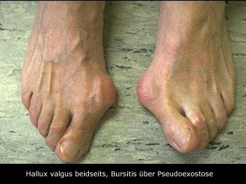 halluxvalgus.jpeg (26683 Byte)